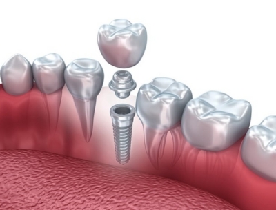 Dental Implants in Yerawada | Le Dental Esthetique
