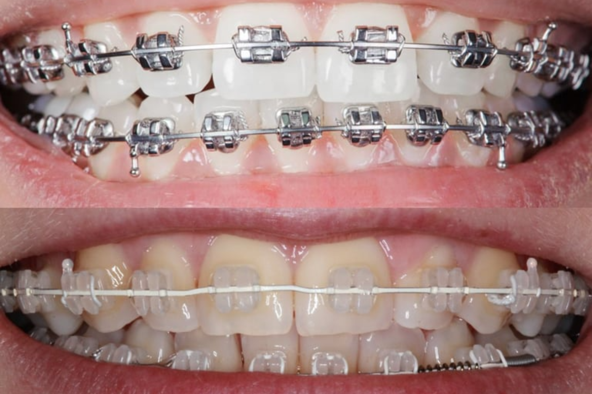 Dental & Ceramic Braces in Yerawada | Le Dental Esthetique