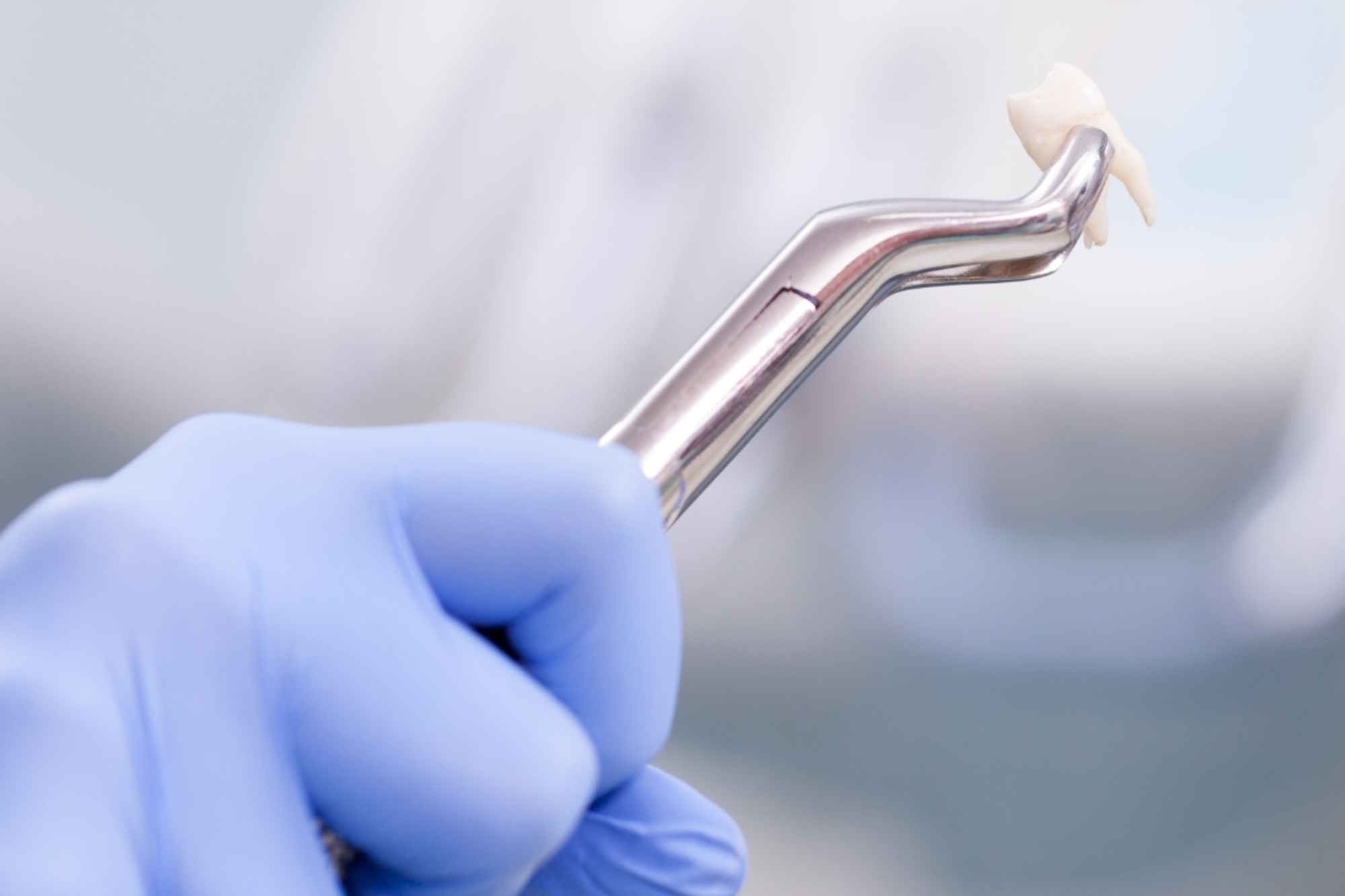 Teeth Extraction in Yerawada | Le Dental Esthetique