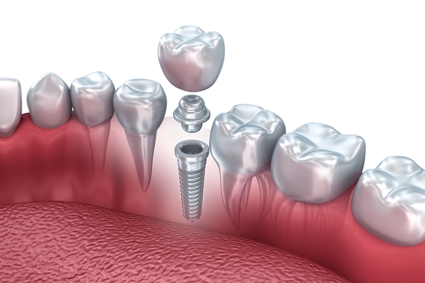 Dental Implants in Yerawada | Le Dental Esthetique