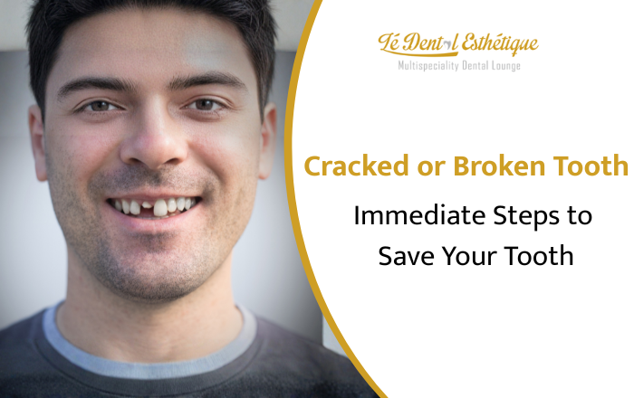 Cracked or Broken Tooth? Here Are the Immediate Steps That Could Save It
