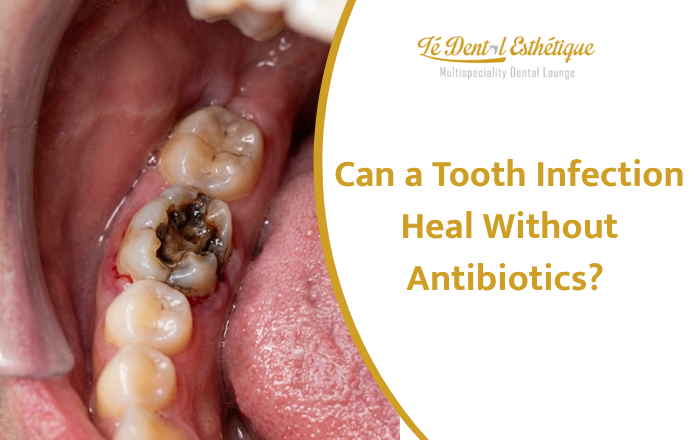 Can a Tooth Infection Heal Without Antibiotics?