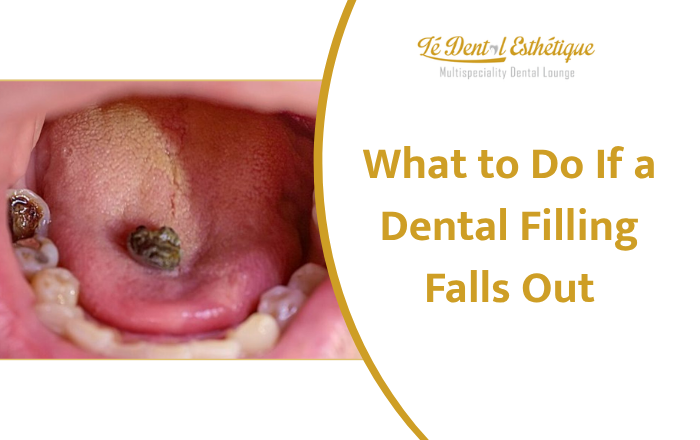 What to Do If a Dental Filling Falls Out